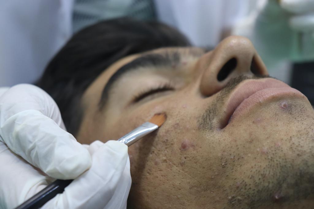Acne Treatment in Wakad