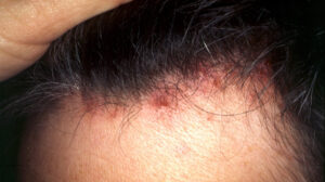 Hair transplant in Pune