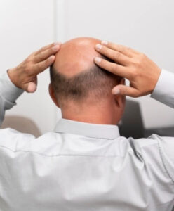 Hair loss Treatment in Wakad