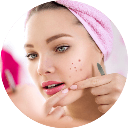 Best Acne Treatment in Pune