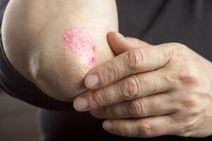 skin allergies Treatment in Wakad