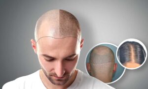 Hair loss Treatment in Pune