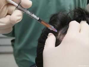 Hair Loss Treatment in Wakad