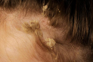 Hair transplant in Pune