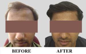 Hair transplant in Pune
