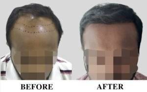 Hair transplant in wakad