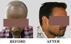 Hair transplant in wakad