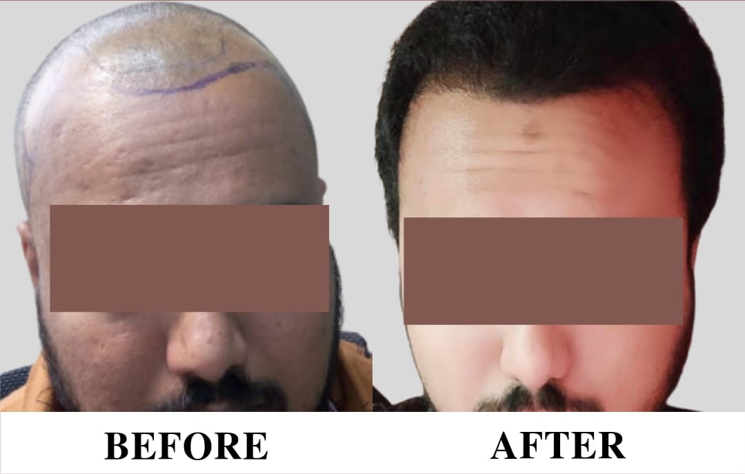 Hair loss Treatment in wakad,