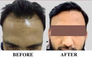 Hair transplant in wakad
