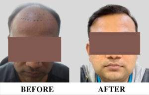 Hair transplant in wakad