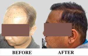 Hair transplant in wakad