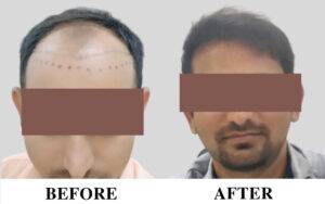 Hair transplant Near me