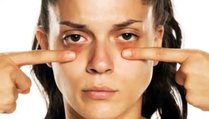 How To Prevent Dark Circles?