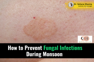 How to Prevent Fungal Infections During Monsoon