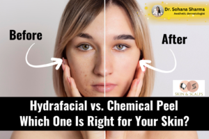 Hydrafacial vs. Chemical Peel: Which One Is Right for Your Skin?