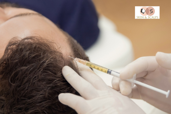 PRP Therapy for Hair Growth: What to Expect