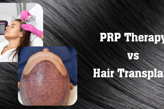 PRP Therapy vs Hair Transplant – Which Gives Better Results?