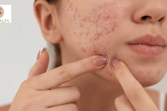 Pimple Treatment in Wakad