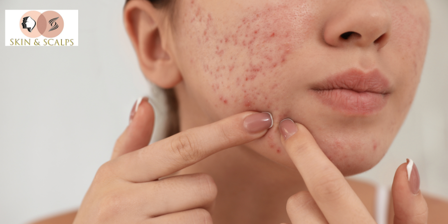 Pimple Treatment in Wakad