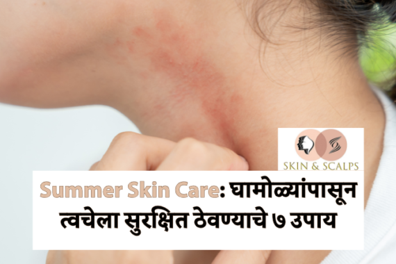Summer Skin Care: घामोळ्यांपासून त्वचेला सुरक्षित ठेवण्याचे ७ उपाय