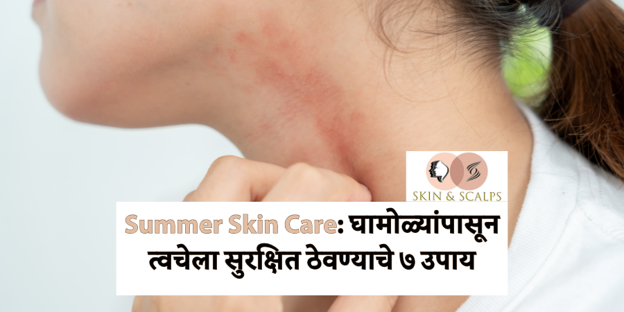 Summer Skin Care: घामोळ्यांपासून त्वचेला सुरक्षित ठेवण्याचे ७ उपाय