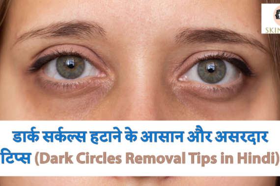 डार्क सर्कल्स हटाने के आसान और असरदार टिप्स (Dark Circles Removal Tips in Hindi)