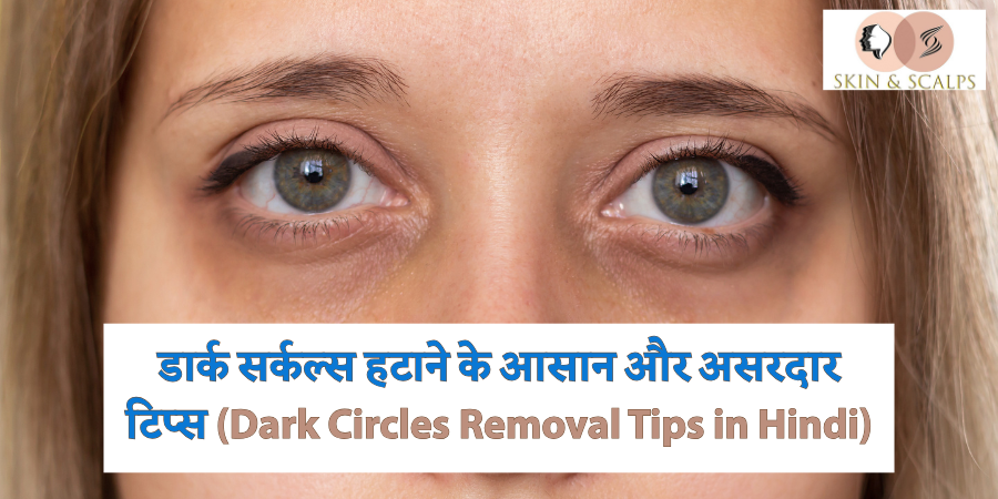 डार्क सर्कल्स हटाने के आसान और असरदार टिप्स (Dark Circles Removal Tips in Hindi)