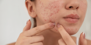 Best Scar Treatment in Wakad | Acne, Surgical & Injury Scar Removal