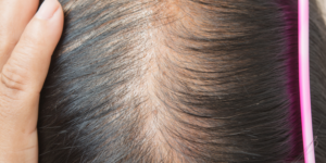 Causes of Hair Thinning and How to Reverse It Naturally