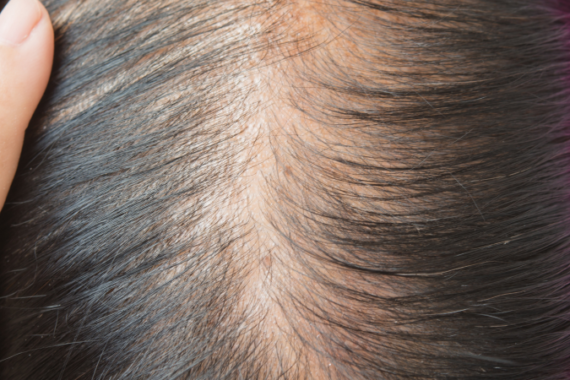 Causes of Hair Thinning and How to Reverse It Naturally