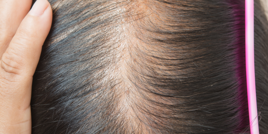 Causes of Hair Thinning and How to Reverse It Naturally