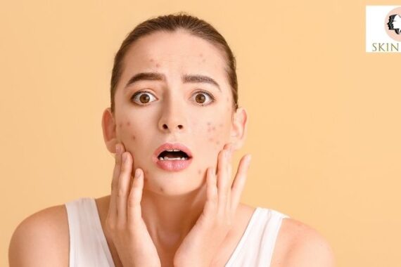 Acne and Skin Problems: Causes, Treatments, and When to See a Dermatologist