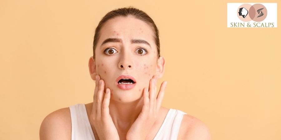 Acne and Skin Problems: Causes, Treatments, and When to See a Dermatologist