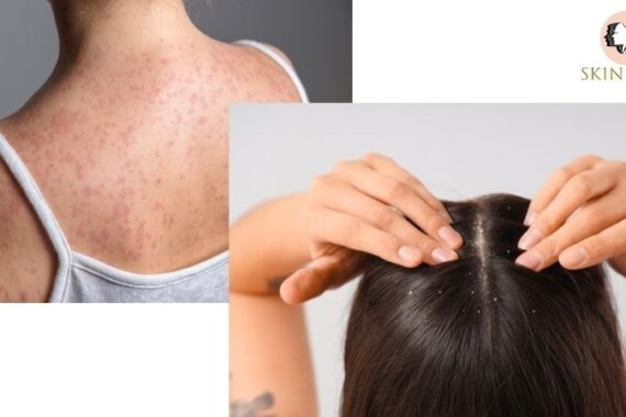 Best Psoriasis Treatment in Wakad Pune Expert Dermatologist Guide