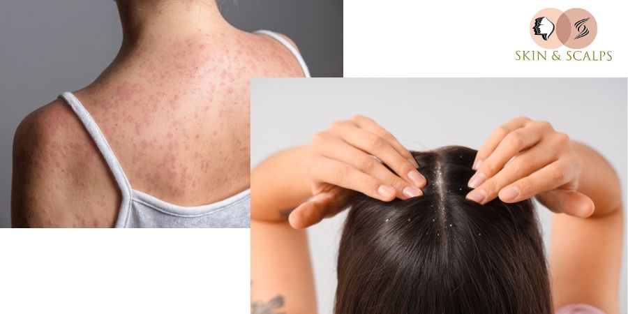 Best Psoriasis Treatment in Wakad Pune Expert Dermatologist Guide