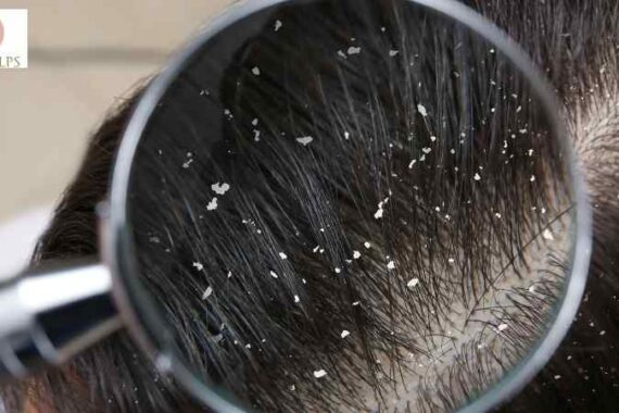 Dandruff Treatment: Causes, Symptoms, Prevention & Best Dermatologist Treatment in Wakad Pune