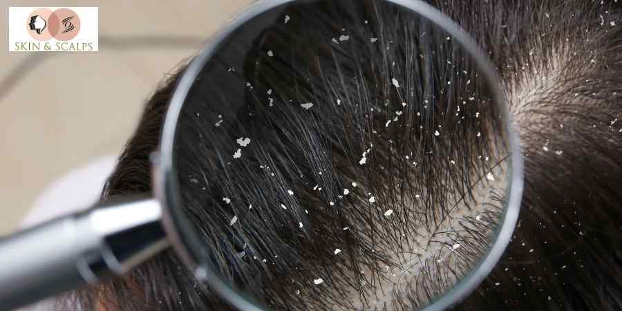 Dandruff Treatment: Causes, Symptoms, Prevention & Best Dermatologist Treatment in Wakad Pune