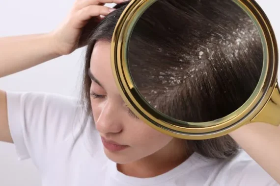 Monsoon Dandruff and Scalp Infections Causes, Prevention and Treatment in Wakad