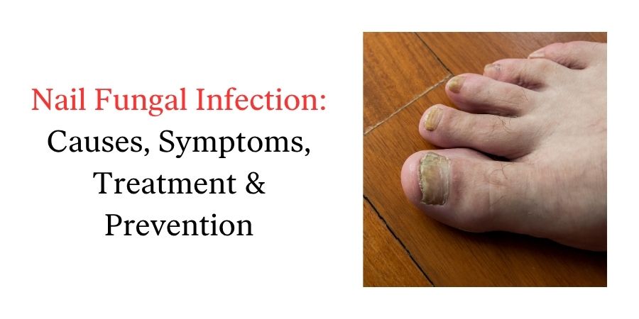 Nail Fungal Infection: Causes, Symptoms, Treatment & Prevention
